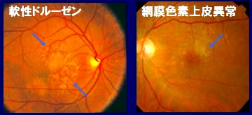 加齢黄斑変性症 ｜ 春日井市 浅野眼科クリニック
