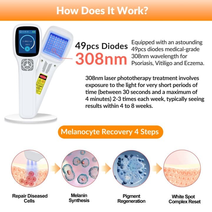 Portable 308nm Excimer UVB Light Therapy Lamp for Professional At