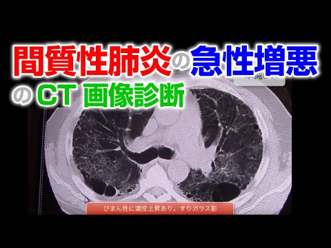 間質性肺炎の急性増悪のCT画像診断【画像診断チャンネル】 - YouTube