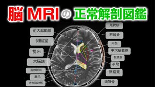 脳MRIの正常解剖図鑑【normal anatomy of brain MRI】 - YouTube
