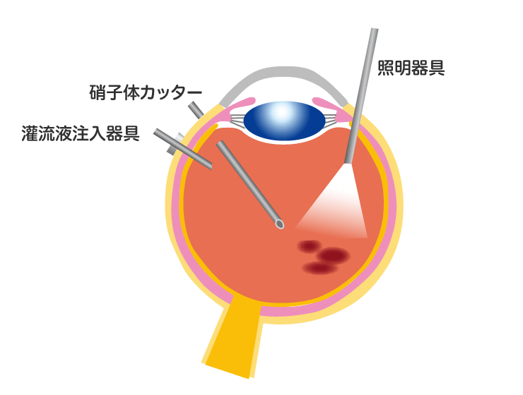 硝子体手術 | 今井眼科医院