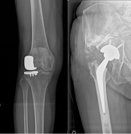 人工関節（再）置換術｜レイクタウン整形外科病院｜埼玉県