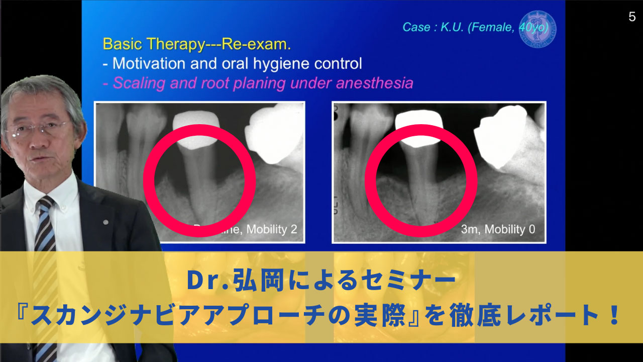 スカンジナビアンアプローチを学ぼう！Dr.弘岡に訊く、臨床的ペリオ